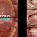 강남미켈란의원 | 틀니와 전체 임플란트 방법 중에, 어떤게 내 구강에 적합할까? 강남 치과에서 같이 알아봐요