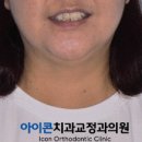 아이콘치과교정과의원 네이버블로그