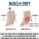 화인마취통증의학과의원수원점 | 수원신경외과추천 허리디스크 초기 '이것' 부터 시작됩니다