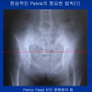 골반변위 X-ray 분석 이미지