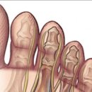 발가락 지간신경종 법 및 정보 원인 이미지