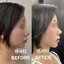 [서울/신논현] 신논현피부과 덴서티 600샷 내돈내산 후기