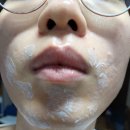 뷰티젠의원 | 남자 수염 레이저 제모 총 15회, 제모 경험담/팁/주의사항에 대하여
