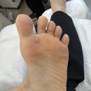 연성프라자 | 천안내성발톱 잘하는 레푸스에서 굳은살제거 후기