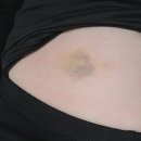 수정-82 | 82년생 40대 난임기록 시험관1차 (2025/10~11월)