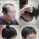 노원가발 전문점 박승철 가발 테잎식 남자부분가발 착용 후기
