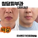 사랑사진실 | 청담피부과 팔자주름 쥬브젠자가진피재생술 내돈내산 후기