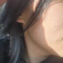 아인셀 | 여드름흉터피부과 패인자국 곰보피부 레이저치료 비용 후기