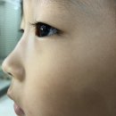 영남안경마트 | [67개월] 6세인생 첫 수술, 대구 가톨릭대학교병원에서 부안검(유아안검내반) 1박2일 수술기록