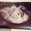 에이스요양병원 | 임신준비 7 _ 시험관 2차 성공. 임밍아웃 9주차 그리고 난임병원 수원 아이오라 졸업