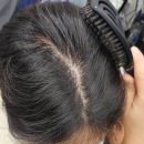 가산약국 | 가산탈모 인들의 성지, 블랙 에서 모발생장술 받고 왔어요