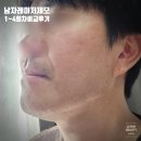 제4남성경로당 | 강남 남자 턱수염 레이저 제모로 남성 피부관리 받은 4회차 후기