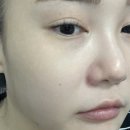 추한의원 | [시술] 압구정 루나의원 루비레이저 981방 : 완전 깨끗해지는 피부 정찰제 가격으로 주근깨가 많을수록...