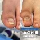 제천내성발톱 교정 치료 후기: 불편함 해방 ! 푸스케어 롯데마트제천점