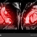 심장 자기공명영상[cardiac magnetic resonance imaging, cardiac MRI] 이미지