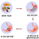 위산과다 원인 증상 속 쓰림 지속될 때 &#39;이것&#39; 주목 이미지