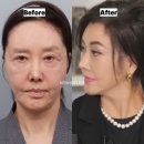 "더 세게 당겨주세요!" 배우 유혜리도 반한 안면거상X눈밑지방재배치 효과부터 부작용까지 싹- 다...