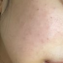 뉴페이스의원 | 부산 뉴페이스의원 리쥬란 후기