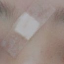 오킴스피부과의원 | 뾰루지 염증주사 경과 후기๑•̀o•́๑_일산 오킴스 피부과 의원