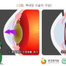 갱신형 백내장진단비보장 특별약관 이미지