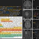 TOF을 이용한 Meningioma VS Hstiocytic sarcoma 감별하기: 또하나의 Clue!! 이미지