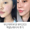 부산대피부과 추천, 잡티 제거 뷰티203의원 엑셀 V 레이저 효과, 후기