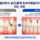 해피스마일치과교정과치과의원 네이버블로그