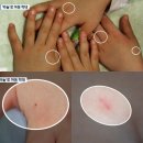 손과바늘 이미지