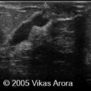 Breast ductal carcinoma 이미지