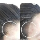 (주)우리라인 | 인천헤어라인문신 라인교정 내돈내산 가격.후기