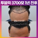 [30대 남자 앞머리탈모 비절개 모발이식 후기] 투블럭 3700모 모발이식 1년 전후 (모엠의원/C자탈모/전지훈원장) 이미지