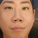 로엔장의원 인모드 FX 포마 풀 페이스 시술후기 이미지