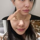 현대의료기계 | 명동 피부과 '올타이트 리프팅' 팔자주름,통증 후기!