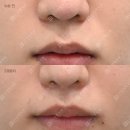 인중 긴 거 유전이라고 포기하려다가 결국 알아본 21성형외과