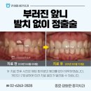 상업용 66 | 앞니 부러졌을 때, 자연치아 보존하는 법 치아정출술 후기 광화문치과
