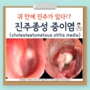 진주종성 만성 중이염[chronic otitis media with cholesteatoma] 이미지