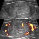 Nodular Goiter (42/F) 이미지