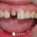 고호치과의원 | 보철치료를 했는데 또 썩었다고요? 수지구청역 치과 치료 후기