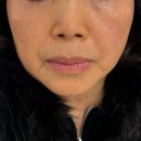 엄마가 | 수원피부과 퀵미니리프팅 상담 시술 후기✨ 엄마가 받고 온 이야기