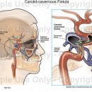 CCF;carotid cavernous fistula(경동맥해면정맥동류) 이미지