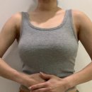 팔 지흡 가격, 흉터 관리 다 알려줌! 결혼다이어트 예비신부 2달차 성공후기