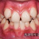 31140-8-23-15 | 15세 송곳니 교정 후기. 발치교정 부작용 겁먹지 마세요.