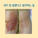 아토파인한의원 | 치유의 기쁨 영원하길, 이비엠한의원, 아토피 근황