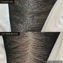 마곡두피문신 SMP 가격 300만원 주고 망한후기