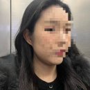 서울 금천구 결혼전 웨딩관리, 리프팅 내돈내산(전후사진있음)