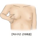 척수구근 근위축증/케네디증후군 이미지