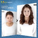 압구정서울성형외과 네이버블로그
