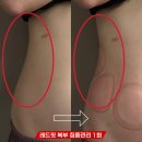 레드핏 | 대전셀룰라이트 없애는 방법 여기있습니다, 레드핏 실제 후기
