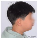 평택 소아치과 돌출입 교정 꼭 발치 없이 개선된 케이스