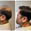 다모아사우나 | 남양주 별내가발 후기 퓨전식 고정식가발로 운동에도 절대 벗겨지지 않는 가발